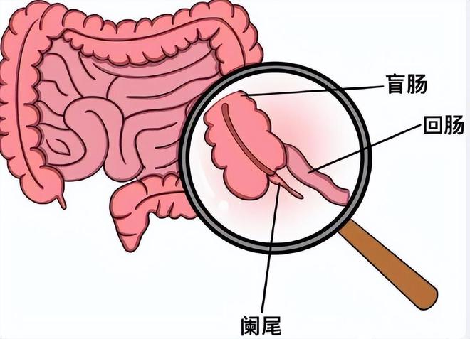 陈乔恩确诊盲肠炎，手术在肚子上打3个洞，切除部位令人心疼