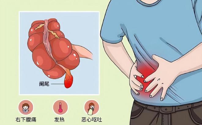 陈乔恩确诊盲肠炎，手术在肚子上打3个洞，切除部位令人心疼
