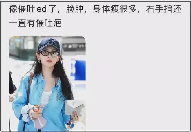 27岁宋祖儿脸部浮肿四肢瘦，疑似进食障碍长期催吐，状态惹人担忧