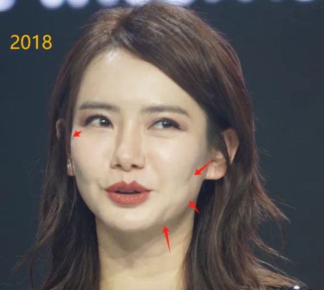 越来越多女星承认整容！有人后悔有人上瘾，动了28次手术停不下来