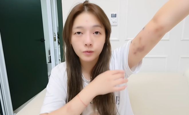 46万粉网红在韩国遭殴打，拒绝搭讪被打到浑身淤青，手指都骨折了