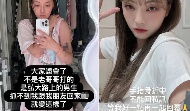 46万粉网红在韩国遭殴打，拒绝搭讪被打到浑身淤青，手指都骨折了