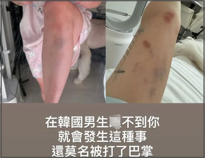 46万粉网红在韩国遭殴打，拒绝搭讪被打到浑身淤青，手指都骨折了