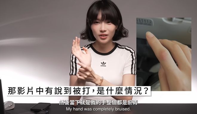 46万粉网红在韩国遭殴打，拒绝搭讪被打到浑身淤青，手指都骨折了